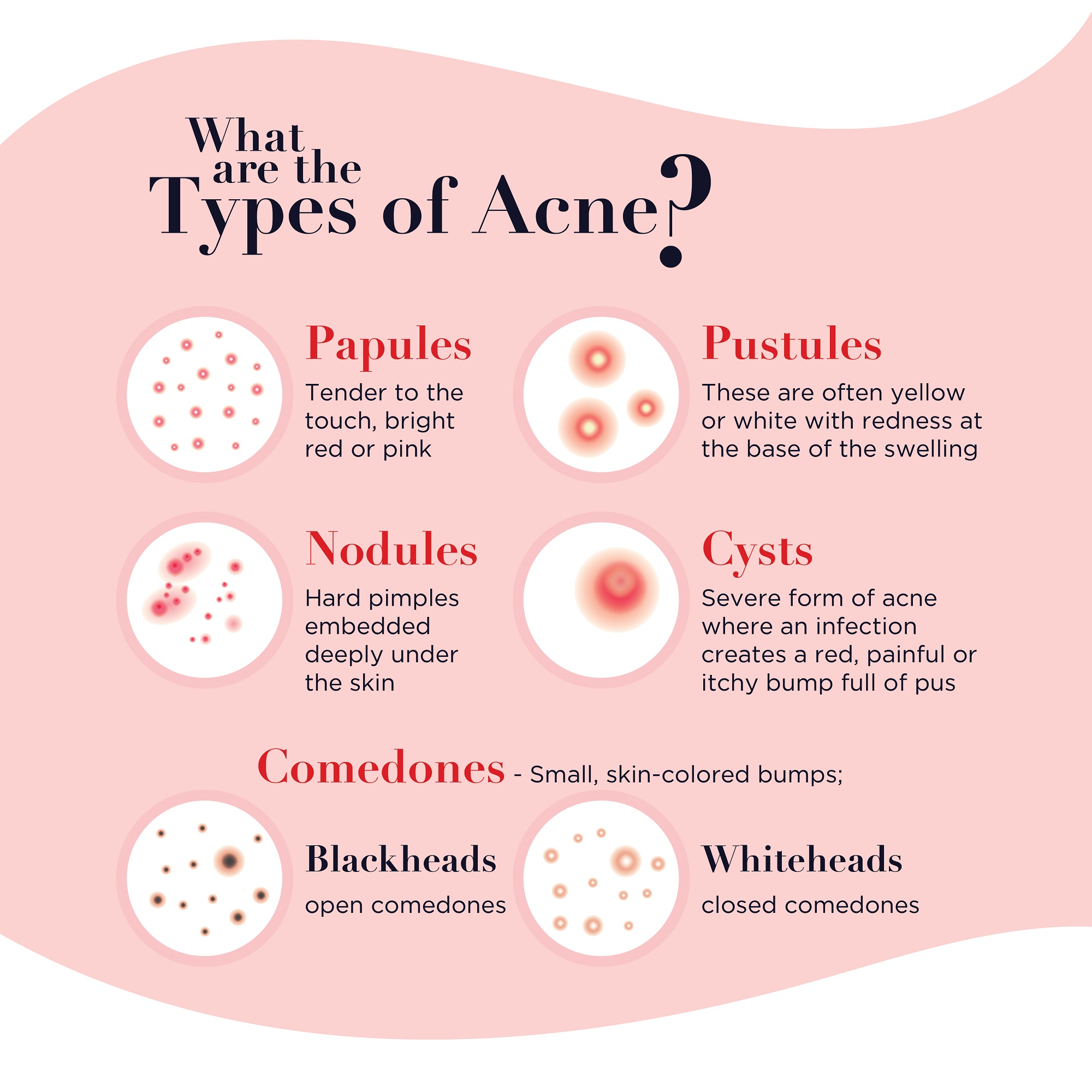 Types Of Acne, Causes, And Treatment (Infographic) | Tips For Natural ...